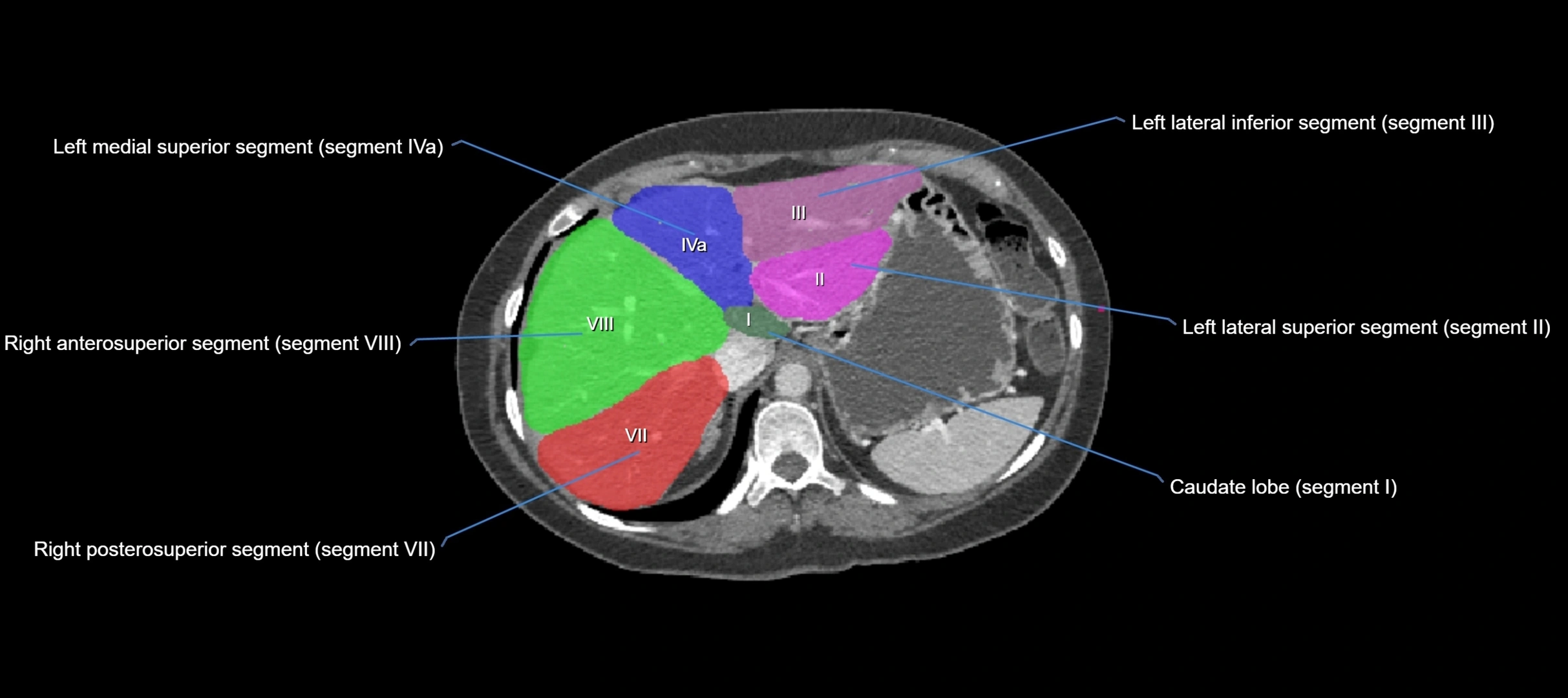 CT liver segments axial cross sectional anatomy labelled image-00056.webp